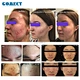 acne treatment solution